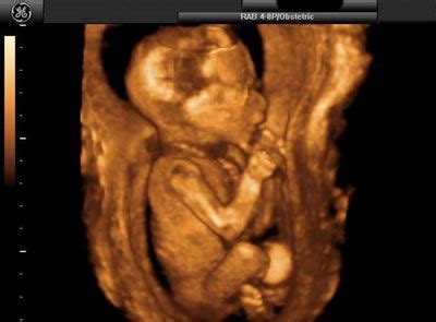 18 week boy baby 3D ultrasound | Innocent and Human | Pinterest | 3d ultrasound, Ultrasound and ...