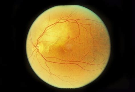 Paracentral Blind Spot And Scotoma - Retina Image Bank