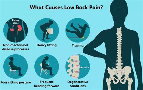 Lower Back Pain - Hip Osteoarthritis - Dr.S.Arumugam's Chennai Ortho