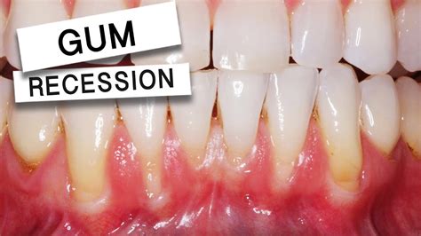 LOOSE TEETH From Gum Recession - TIGHTENED UP with The Pinhole Technique - YouTube