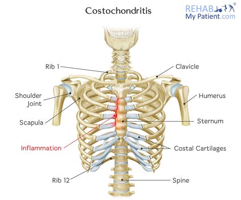 Costochondritis | Rehab My Patient Health Habits, Health Tips ...