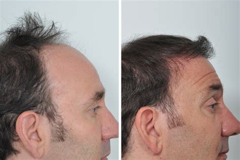 Hair Restoration, Hair Transplant Surgery for Men in New York City ...