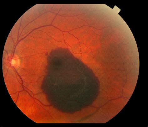 Wet Macular Degeneration Symptoms, Causes, Diagnosis and Treatment - Natural Health News