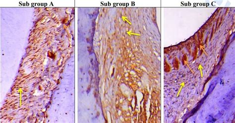 Sub Gp A: A photomicrograph of the PDL fibers of group II at 7 th day ...