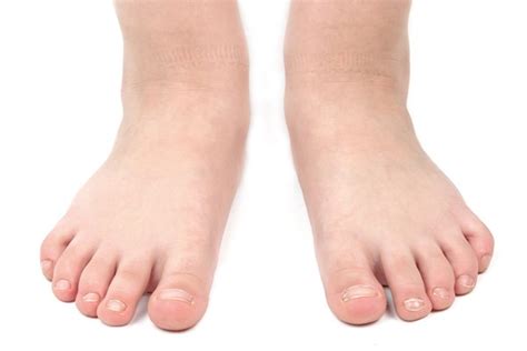 Problem Children's Feet Treatment Edmonton Alberta: The Foot Institute