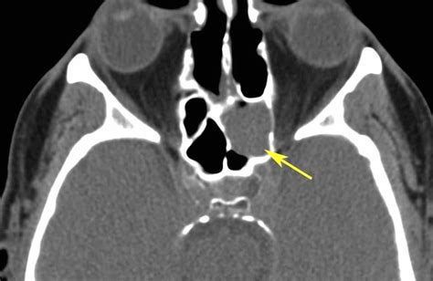 RiT radiology: Sphenoid Sinus Mucocele