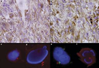 Centrosome abnormalities in giant cell tumour of bone: possible association with chromosomal ...