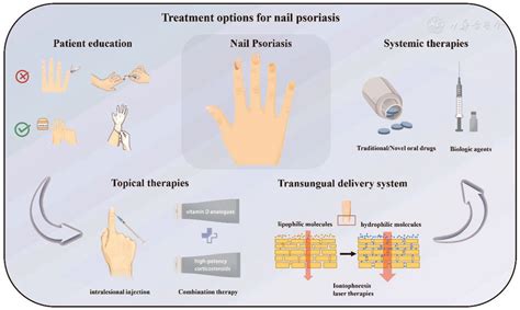 Nail Psoriasis: Treatment Options and Management Strategies in Special ...