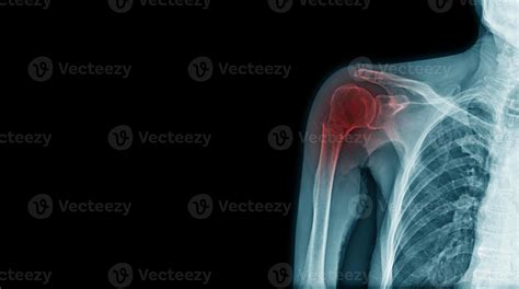 x-ray fracture of acromion process and neck of humerus 6755141 Stock ...