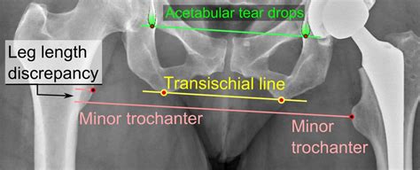 Leg Length Discrepancy - Physiopedia