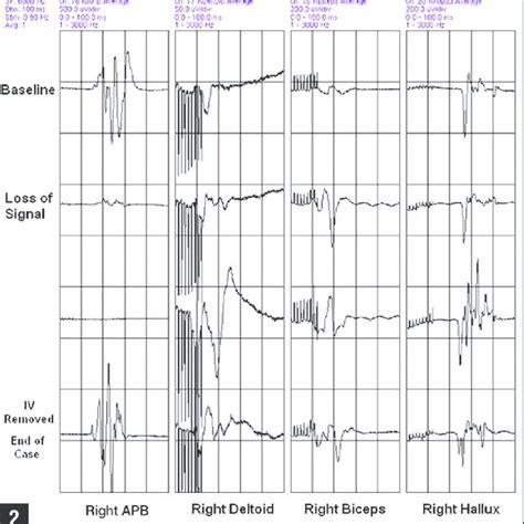 Somatosensory-evoked potentials signals monitoring showing loss of ...