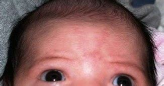 Study Medical Photos: A Baby Girl In The Nursery Has Hypertelorism