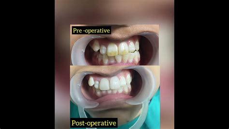 Different stages of dental fluorosis - Dental Clinic