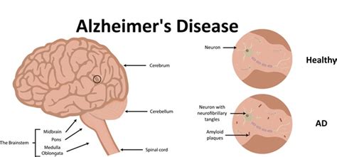 Alzheimer’s tangles and plaques: what’s the difference?