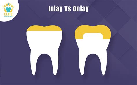 Inlay Vs Onlay | Elite Dental Care