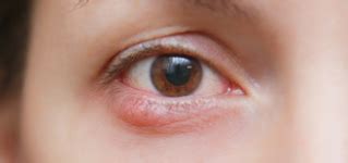 What Is a Stye? - Optometrists.org