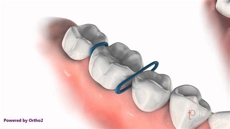 Orthodontic Spacers - YouTube