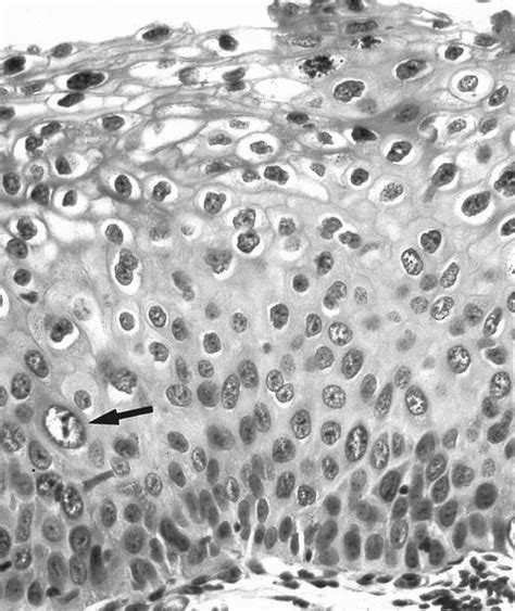 Pathology Outlines - HSIL (CIN II - moderate dysplasia, CIN III ...