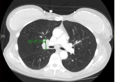 Neurocognitive deficits in a patient with small cell lung cancer: a case report | Cases Journal ...