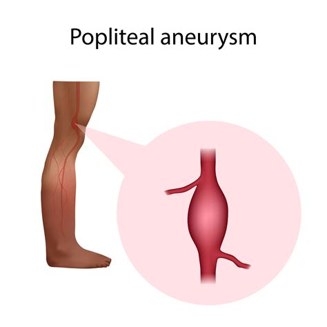 Popliteal Artery Aneurysm - Treatment and Symptoms