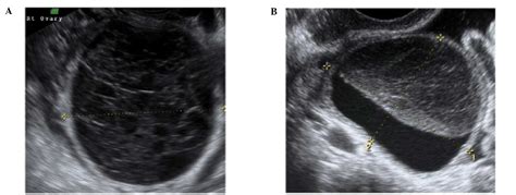 The characteristic ultrasound features of specific types of ovarian ...