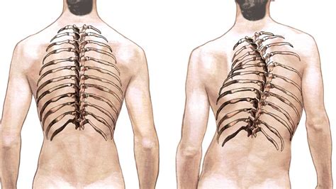 Spinal Curvature and Deformity - Scoliosis, Kyphosis and Lordosis