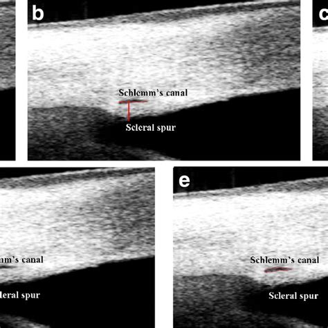 Receiver operating characteristic curves for scleral spur length and ...