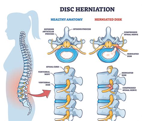 Slipped Disc Treatment, Symptoms & Causes | ANSSI