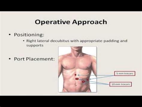 Laparoscopic Subtotal Splenectomy • Video • MEDtube.net