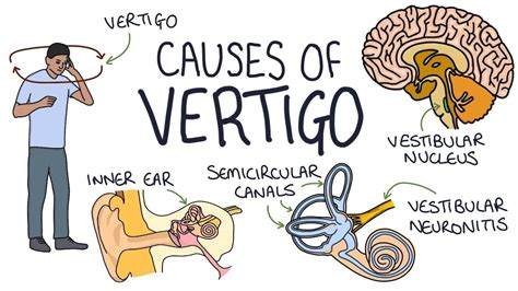 Understanding the Causes of Vertigo - YouTube | Vertigo, Vertigo causes, Medicine book