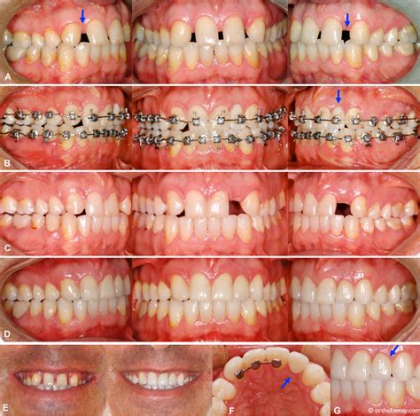 Lateral incisors anodontia, congenital absence and orthodontic correction