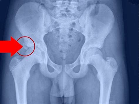 Sports Injury Bulletin - Diagnose & Treat - Hip avulsion injuries: getting the full management ...