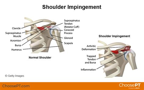 Guide | Physical Therapy Guide to Shoulder Impingement Syndrome | Choose PT