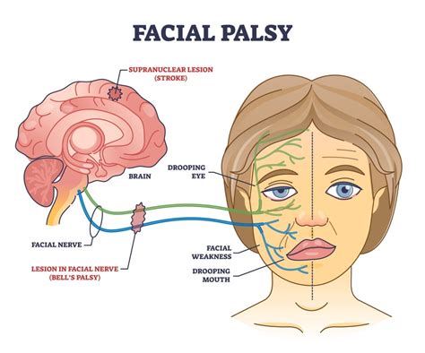 Bell's Palsy: What Is It And How To Treat It? - GulfPhysio