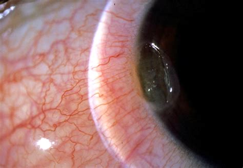 Ophthalmology Dx: Rubbed His Eye the Wrong Way- Ophthalmology Advisor