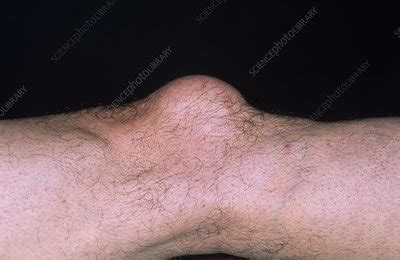 Bursitis of the knee - Stock Image - M120/0133 - Science Photo Library