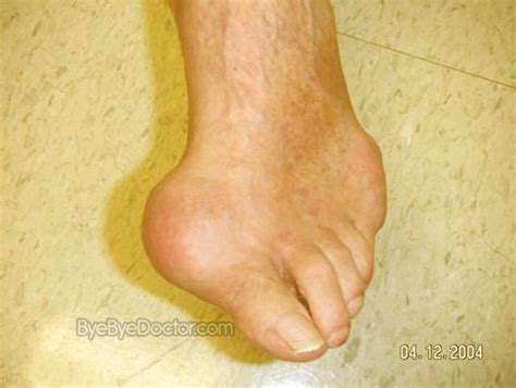 Gout – Symptoms, Diet, Causes, Treatment, Pictures, Medication