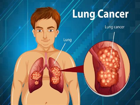 Lung Cancer: Symptoms, Causes, Diagnosis, and Treatment