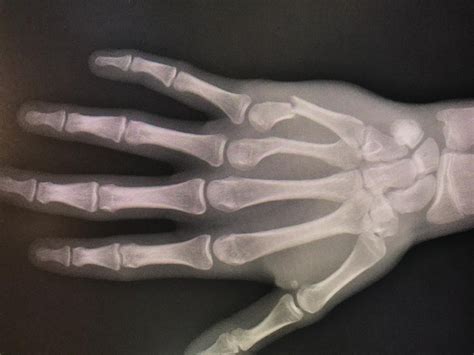 Metacarpal Fractures | The Best Porn Website