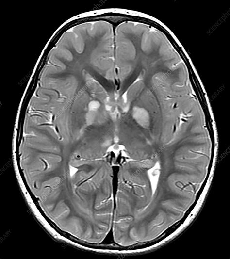 Neurofibromatosis type I (NF1), MRI - Stock Image - C036/5245 - Science Photo Library