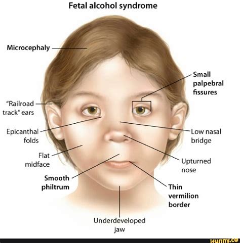 Fetal alcohol syndrome Microcephaly Small palpebral - iFunny