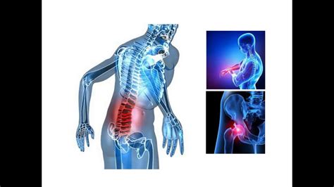 Symptoms of Multiple Myeloma Stage 1 - Ostomy Lifestyle