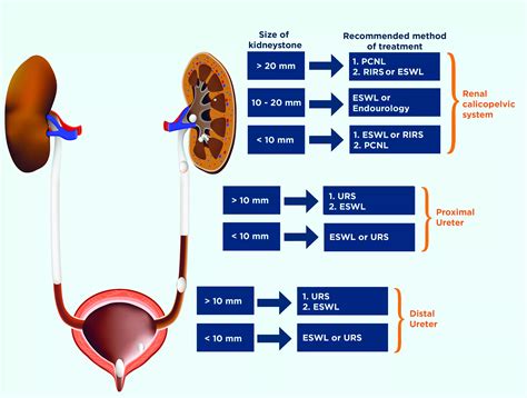 Kidney stones and treatment methods — Dornier MedTech Americas