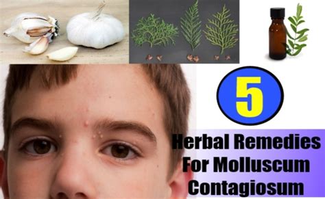 5 Best Herbal Remedies For Molluscum Contagiosum – Natural Home Remedies & Supplements