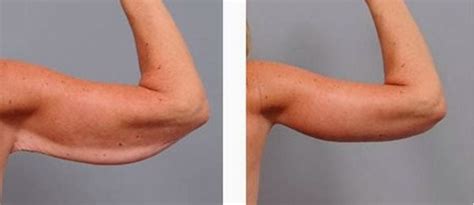 Brachioplasty (Arm Lift) Plastic Surgery Before And After Photos Atlanta GA