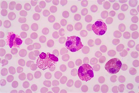 Eosinophilic Disorders | Eosinophilia | MedlinePlus