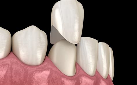 Porcelain Crowns - Keys Dental Specialists