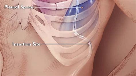 Aspira Drainage Catheter Procedure | Catheter, Drainage, Procedure