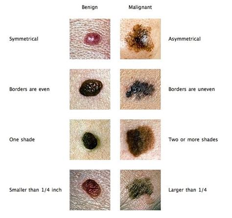 27 best Moles, Warts And Skin Tags images on Pinterest | Health, Home remedies and Skin problems