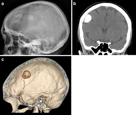 A 59-year-old female with back pain and an abnormal bone scan that ...